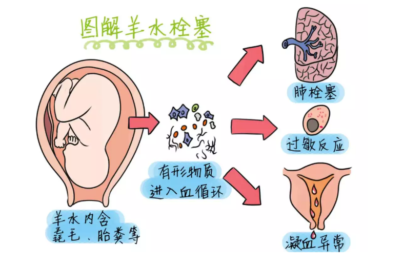 宜昌鑫家圆妇产医院：什么是羊水栓塞？