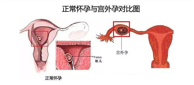 宜昌鑫家圆妇产医院：为什么宫外孕越来越多？